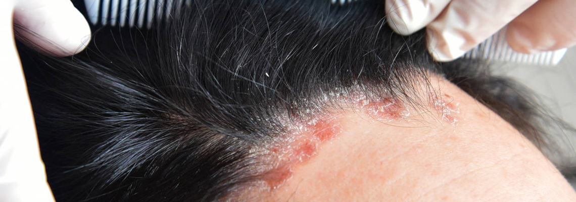 psoriasis du cuir chevelu